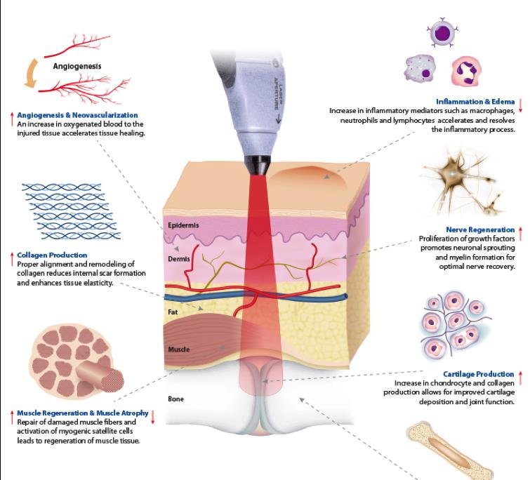 Suyzeko LLLT Laser Watch: A Practical Guide for U.S. Naturopathic Doctors — does low level laser therapy work.JPG
