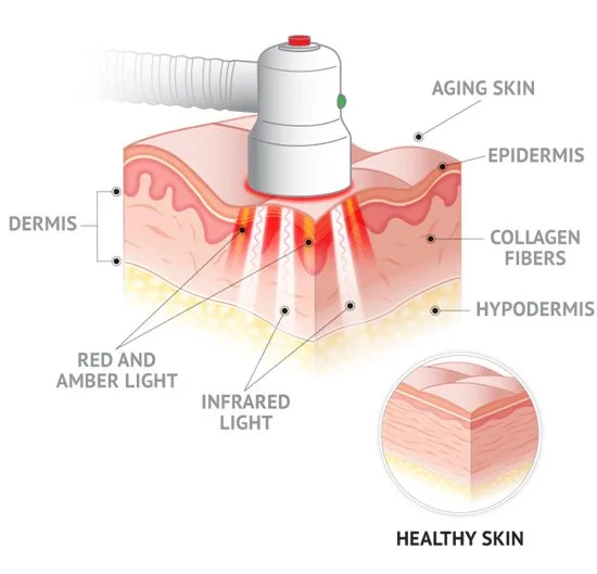 Suyzeko LLLT Laser Watch: A Practical Guide for U.S. Naturopathic Doctors — does low level laser therapy work 9.jpg